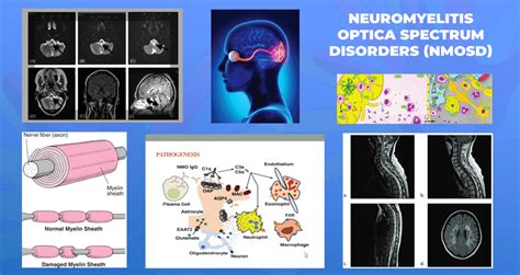 fiona costello|Neuromyelitis Optica Spectrum Disorders